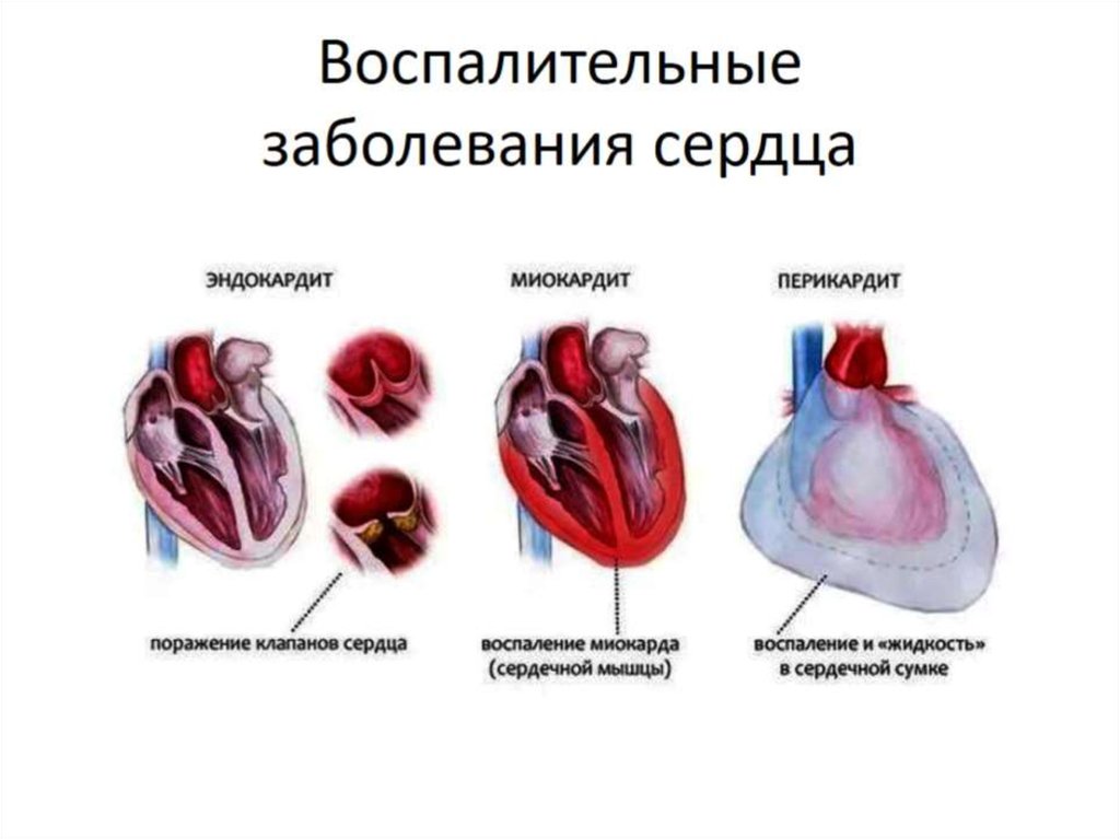 Гипертоническое поражение сердца. Эндокардит миокардит перикардит. Воспалительные заболевания сердца перикардит. Воспалительные процессы в сердце эндокардит миокардит перикардит. Воспаление сердечных клапанов.