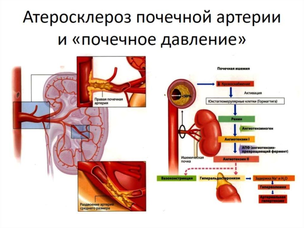 Атеросклероз почечной артерии и «почечное давление»