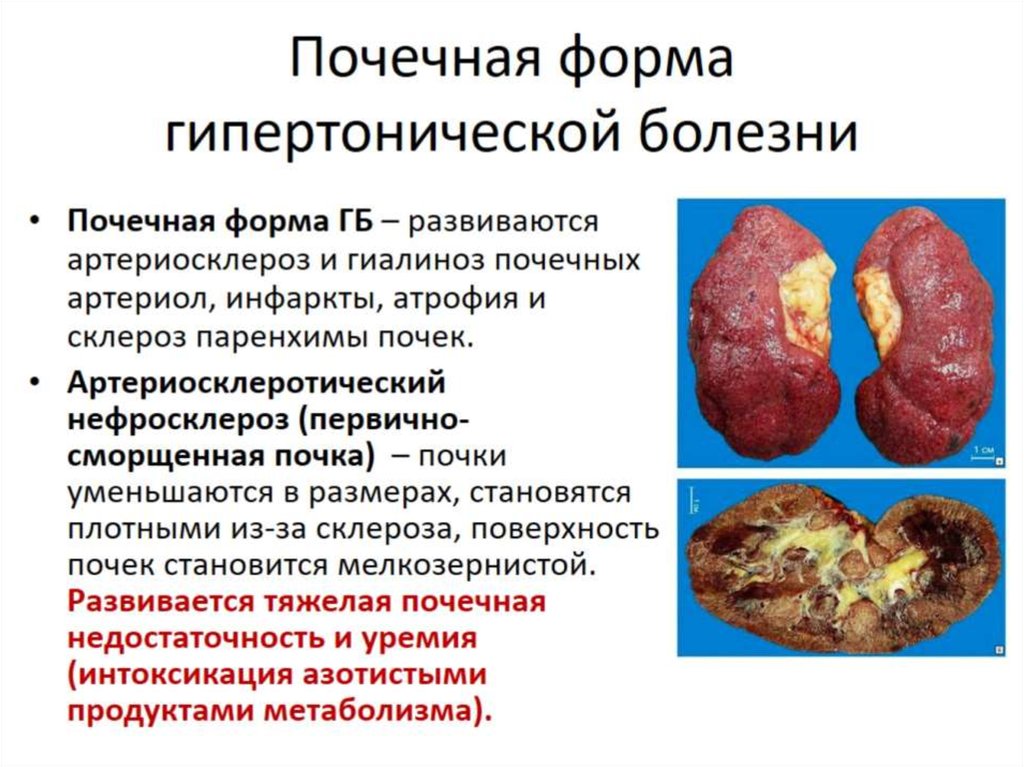 Почечная форма гипертонической болезни