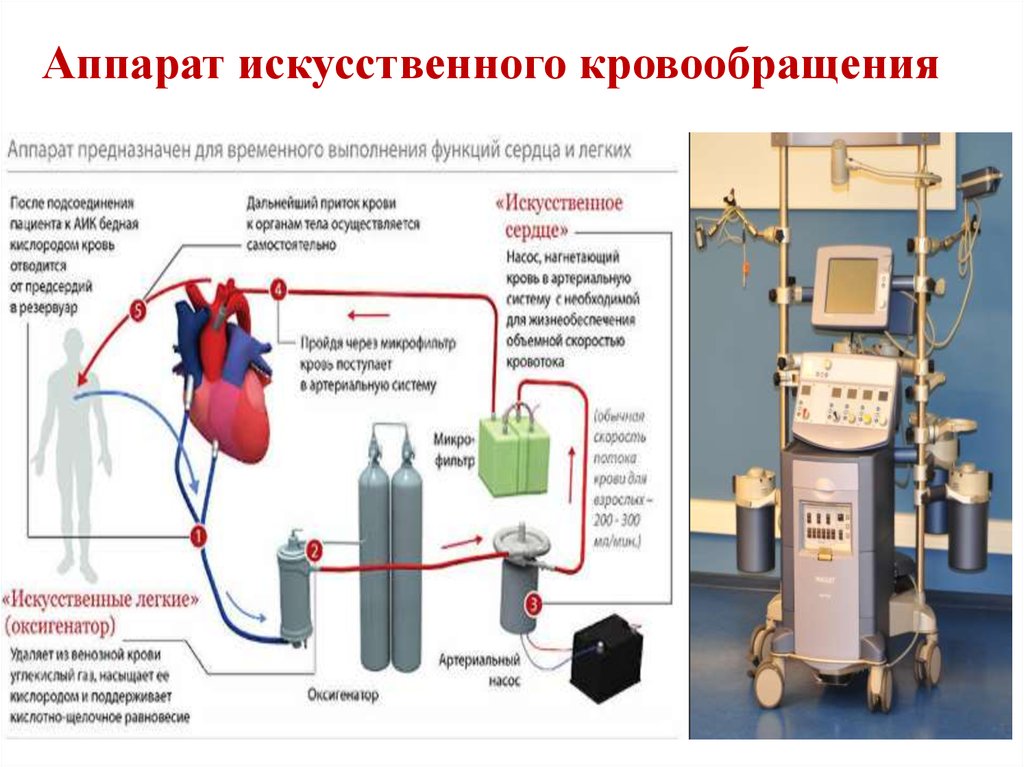 Изображение аппарата использующегося в сосудистой хирургии