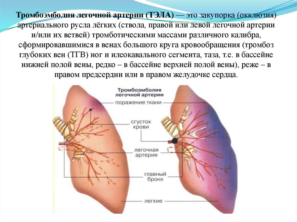 Артериальная тромбоэмболия. Тромбоэмболия ветвей легочной артерии. Эмболия тромбом легочной артерии (Тэла);. Тромбоз мелких ветвей легочной артерии.