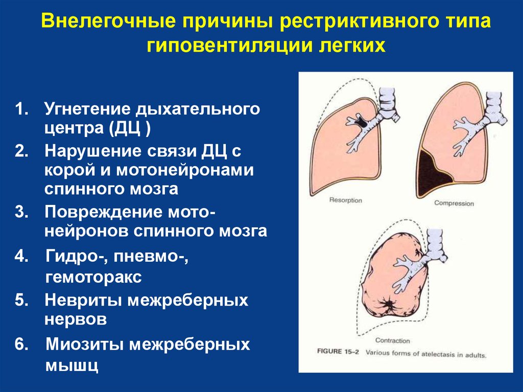Причины нарушения дыхания. Вентиляционные нарушения легких рестриктивного типа. Рестриктивная форма дыхательной недостаточности. Причины рестриктивного типа гиповентиляции. Причина, вызывающая рестриктивный Тип гиповентиляции.