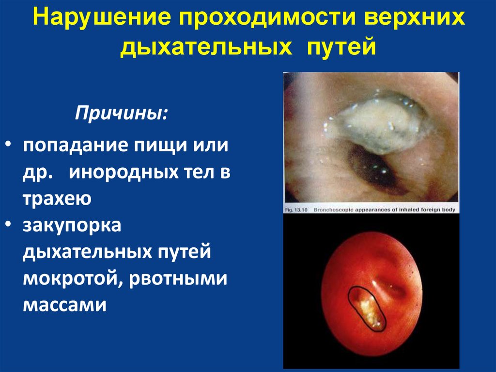 Нарушение проходимости верхних дыхательных путей
