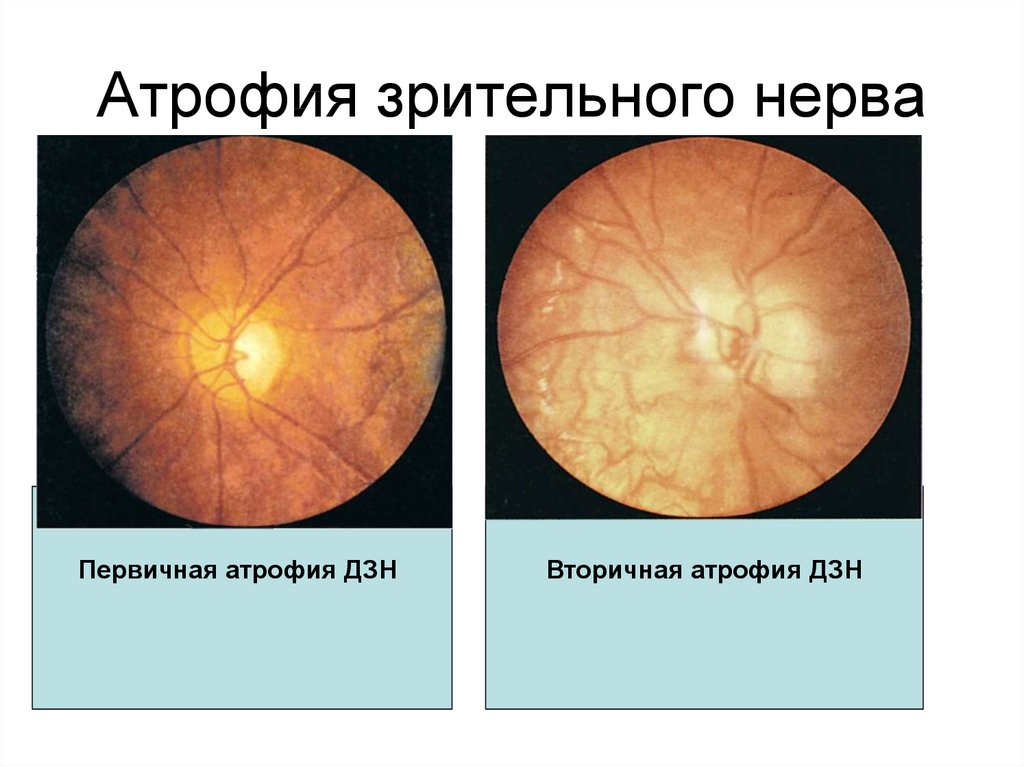 Лечение глазного нерва. Первичная и вторичная атрофия диска зрительного нерва. Вторичная постзастойная атрофия зрительного нерва. Атрофия зрительного нерва клиника.