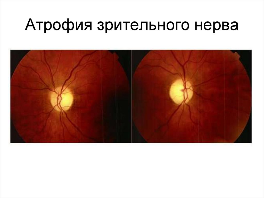 Нейропатия глаза. Атрофия зрительного нерва Лебера. Нейропатия зрительного нерва Лебера.