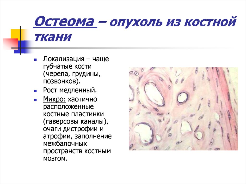 Доброкачественная ткань. Губчатая костная ткань локализация. Остеома макропрепарат описание. Остеома патологическая анатомия.