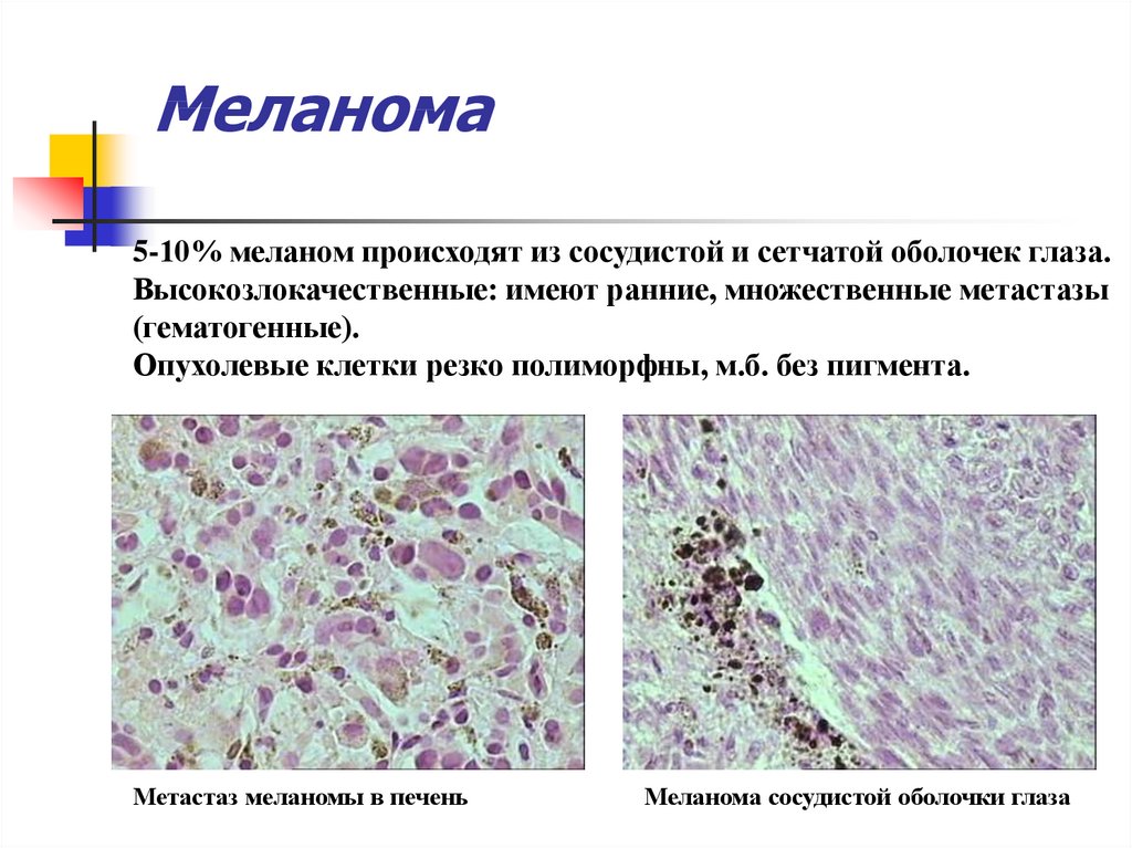 Метастаз рака в лимфатический узел. Меланома препарат патанатомия. Меланома кожи патологическая анатомия препарат. Меланома кожи описание макропрепарата. Поверхностная меланома гистология.