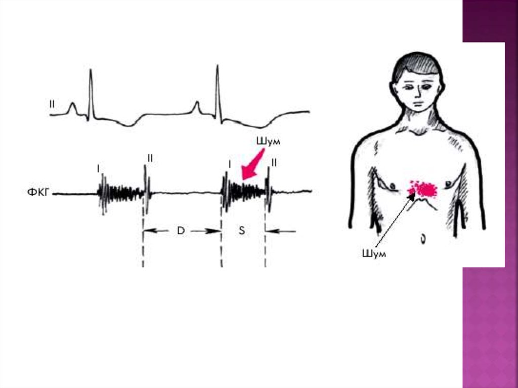 Шумы в сердце. Шумы сердца. ФКГ шумы. Шумы на фонокардиограмме. Систолический шум на ФКГ.