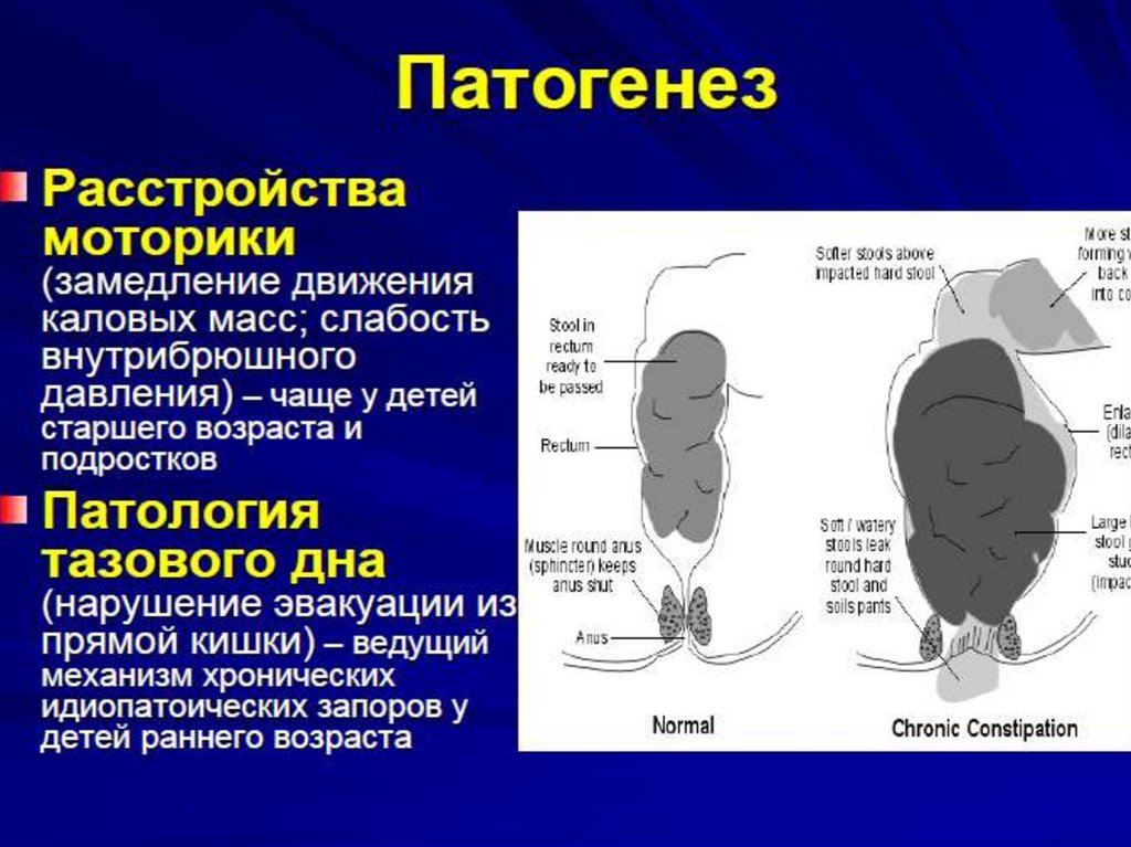 Запоры у детей презентация