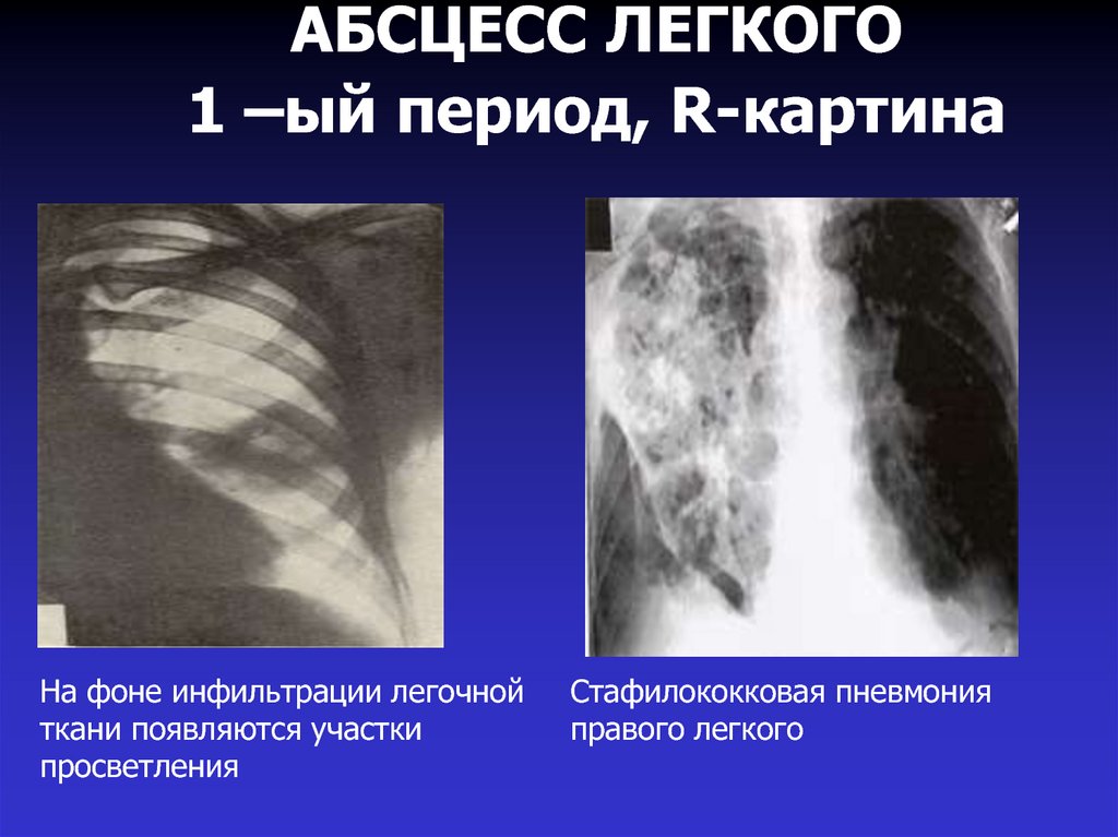 Абсцесс легкого презентация