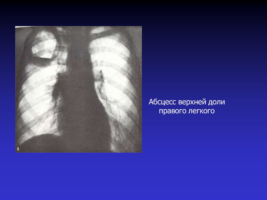 Правого верхней доле. Абсцесс средней доли правого легкого рентген. Острый абсцесс нижней доли правого легкого. Абсцесс рентген верхней доли. Абсцесс верхней доли правого легкого.