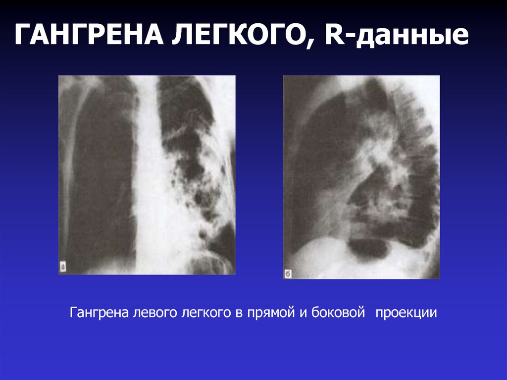 Лечение гангрены легкого. Лобарная гангрена легкого. Гангрена легкого на рентгенограмме. Гангрена левого легкого. Тотальная гангрена легкого.