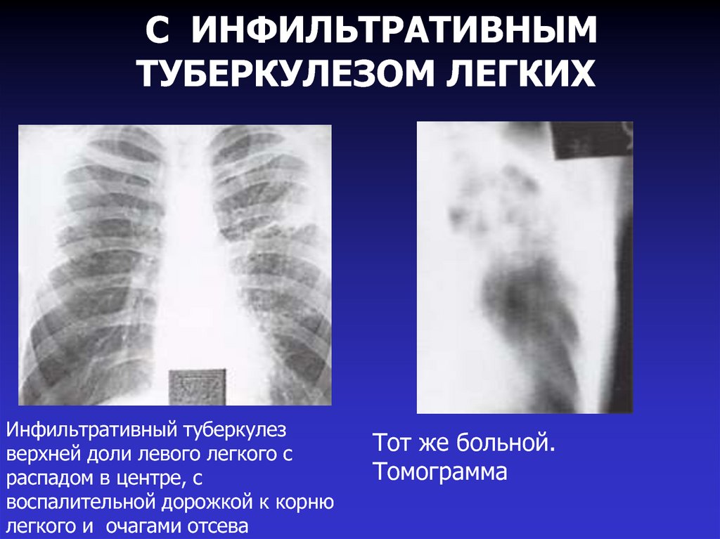 Инфильтративный туберкулез легких презентация