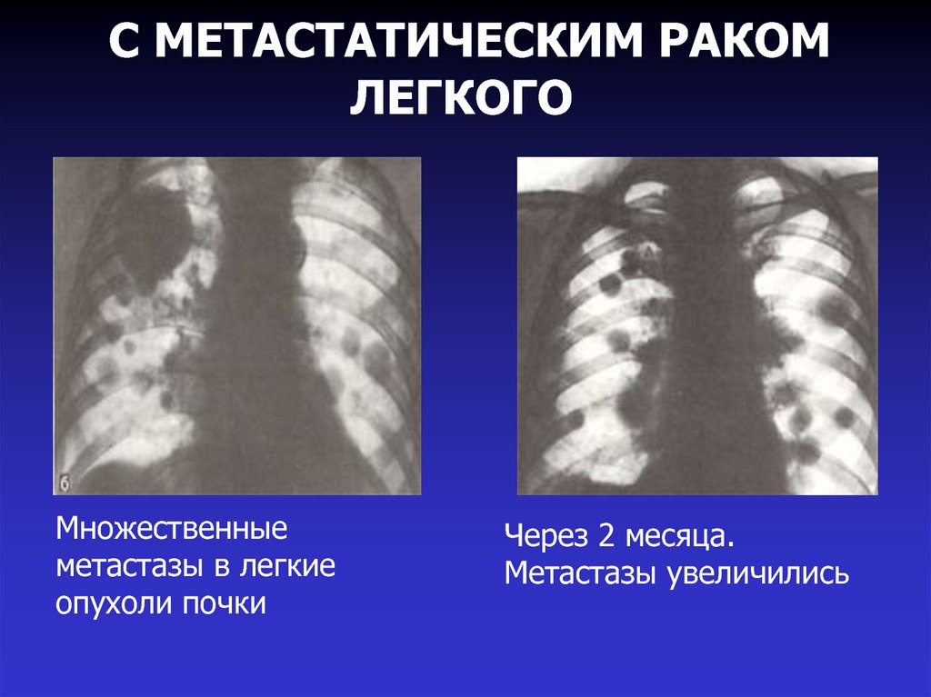 Метастазы в легких фото легких