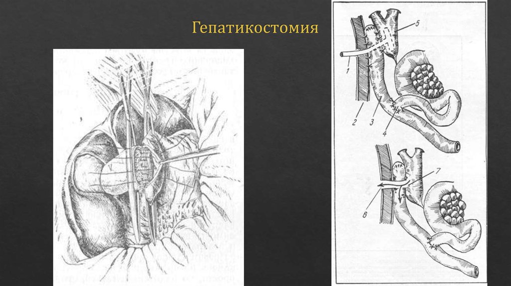 Гепатикостомия
