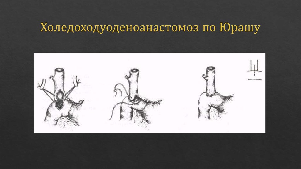 Холедоходуоденоанастомоз по Юрашу