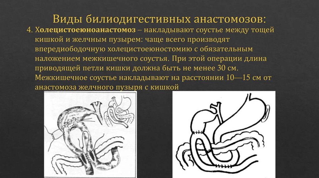 Анастомоз по брауну схема