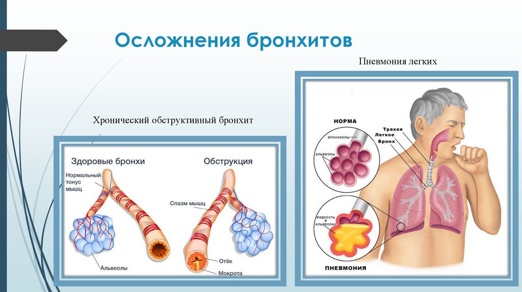 Хронический острый бронхит презентация