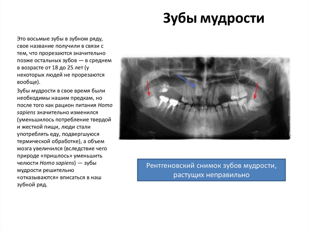 Зуб мудрости фото какой по счету