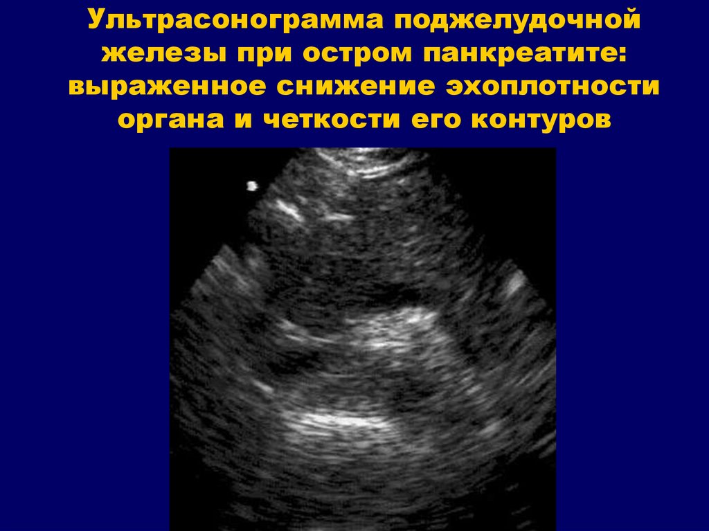 Признаки образования поджелудочной железы. Острый панкреатит сонография. Аденома поджелудочной железы на УЗИ. Ультрасонограмма поджелудочной железы. Острый панкреатит поджелудочной железы.