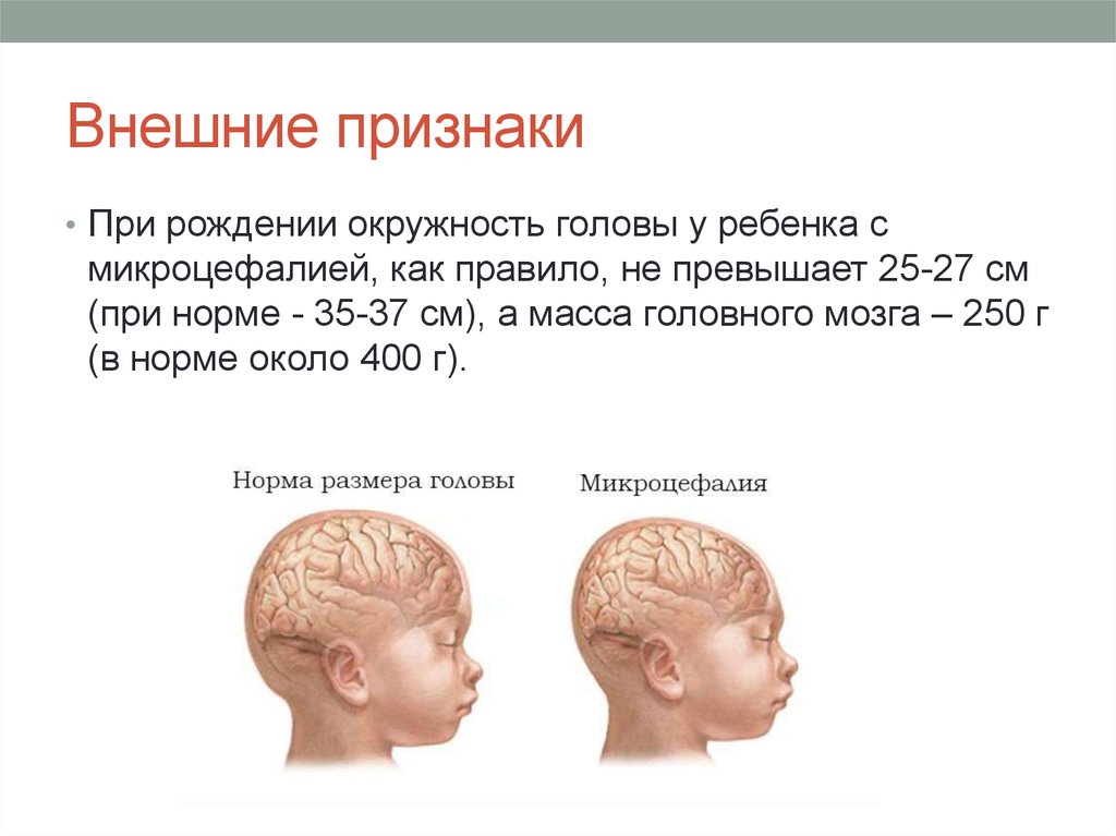 Окружность головы при рождении. Микроцефалия окружность головы. Обхват головы при микроцефалии. Микроцифалияголовного мозга.