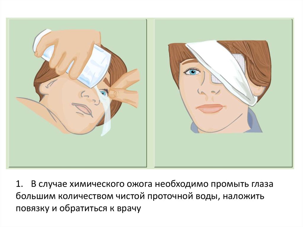 Попадание в глаз кислоты. При ожогах глаз необходимо. Оказание помощи при ожоге глаз. Оказание первой помощи при ожогах глаз. Оказание помощи при химическом ожоге глаз.