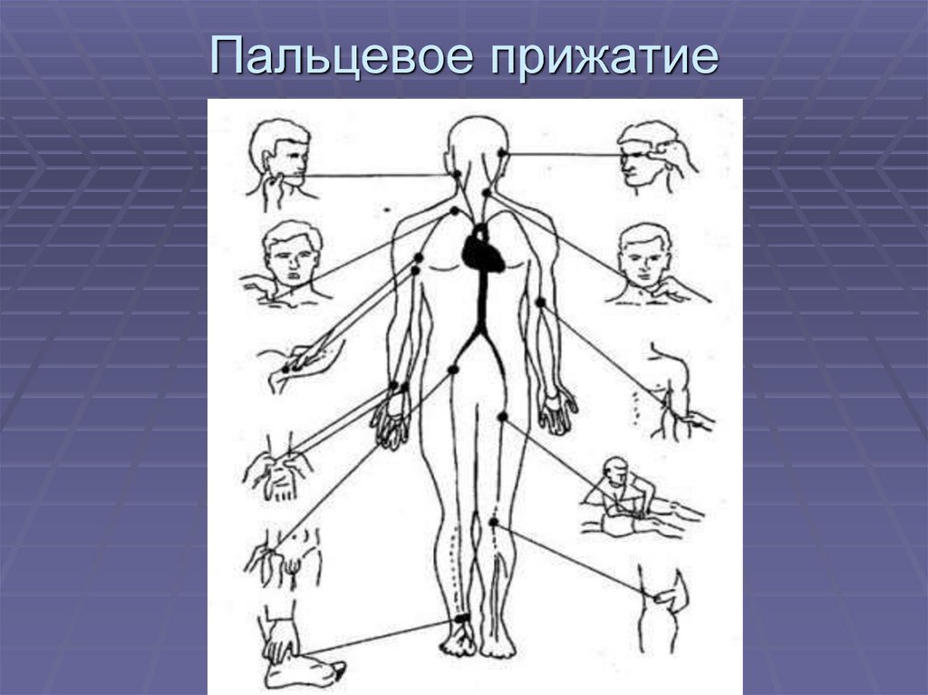 Пальцевое прижатие. Пальцевое прижатие артерий на протяжении. Схема пальцевого прижатия. Техника выполнения пальцевого прижатия артерий при кровотечениях.