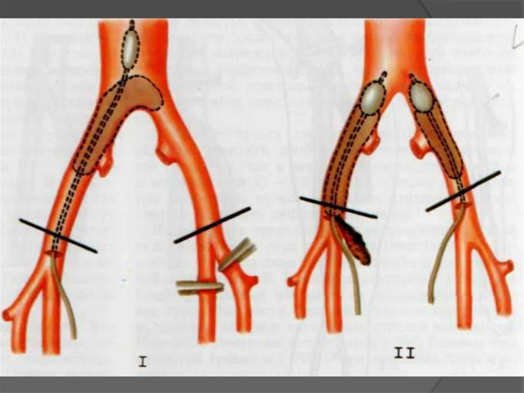 Артерия тромб удаление. Тромбэктомия катетером Фогарти. Тромбэктомия из бедренной артерии. Непрямая тромбэктомия катетером Фогарти.
