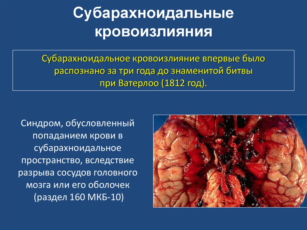 Синдром, обусловленный попаданием крови в субарахноидальное пространство, вследствие разрыва сосудов головного мозга или его