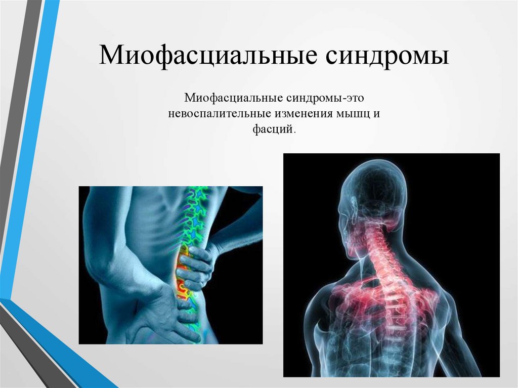 Миофасциальный болевой синдром. Миофасциальные синдромы. Профилактика миофасциального синдрома. Гипердинамия. Гипердинамия презентация.