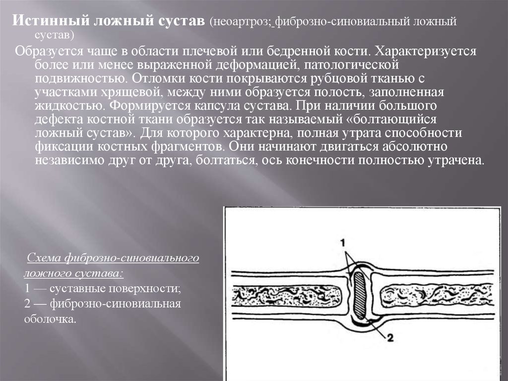 Ложный сустав презентация