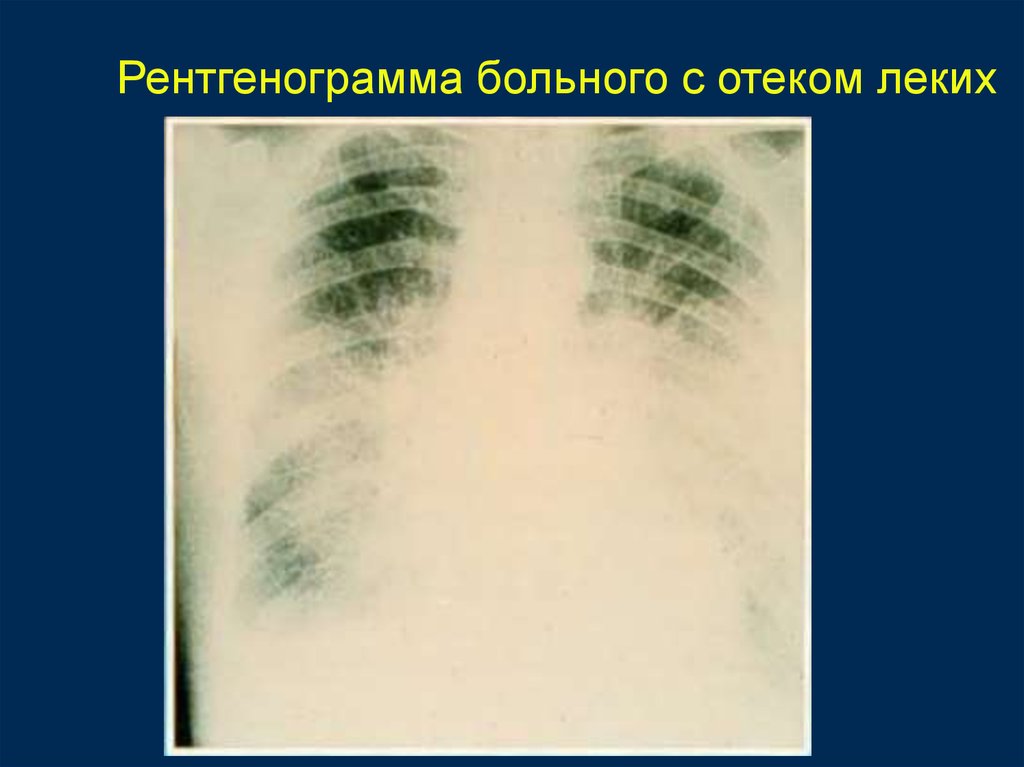 Отек легких рентгенологическая картина