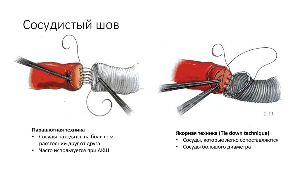 Шов артерий