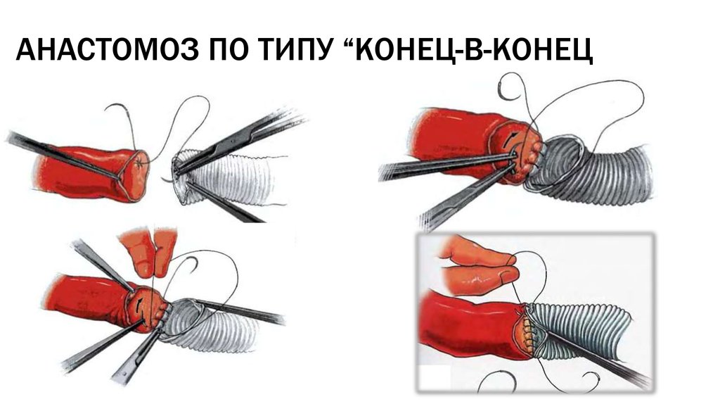 Техника конца. Сосудистый анастомоз конец в конец. Сосудистый анастомоз конец в бок. Сосудистый анастомоз конец в конец техника. Анастомоз сосудов конец в конец.