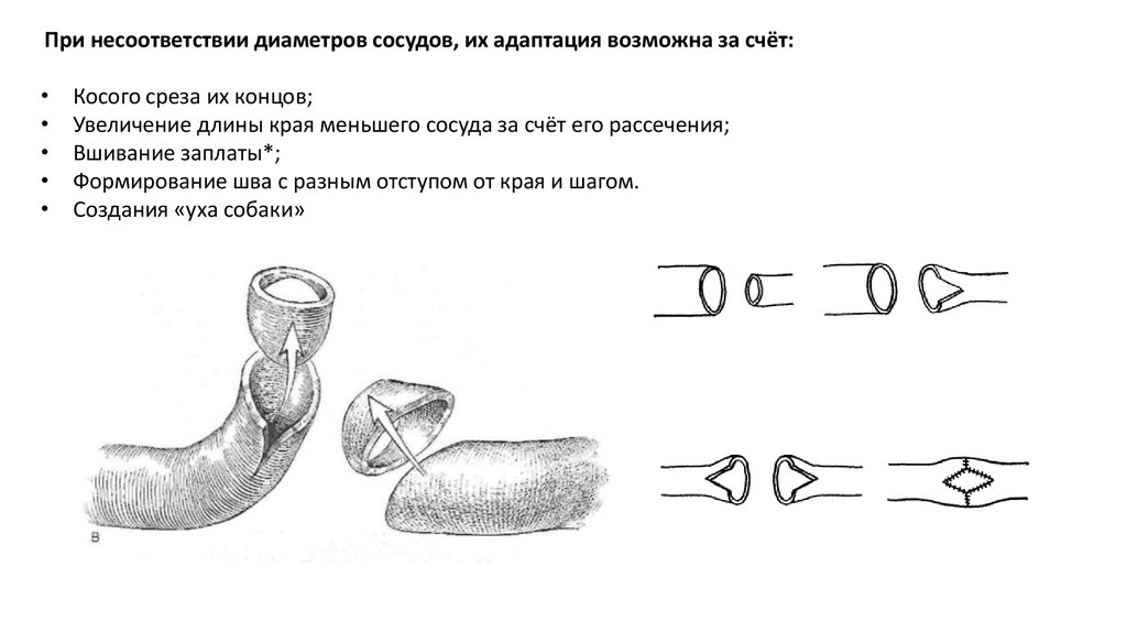 Диаметр сосудов. Наложение сосудистого шва при несоответствии диаметров сосуда. Способ наложения шва при несоответствии диаметров сосудов.