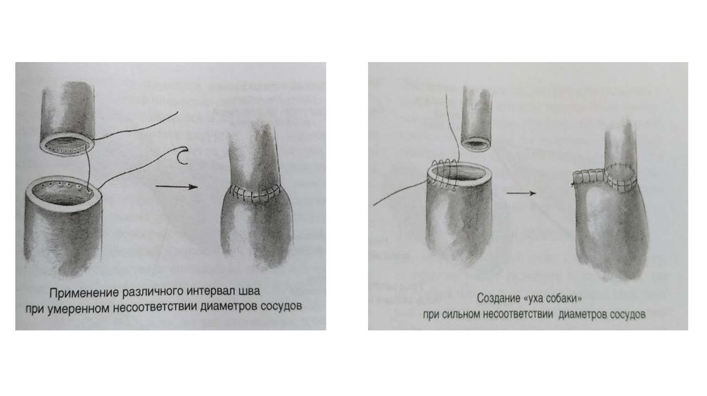 Сосудистый шов методы наложения. Шов Сапожникова сосудистый. Сосудистый шов, понятие о микрохирургии. Методы наложения сосудистого шва. Требования к сосудистому шву.