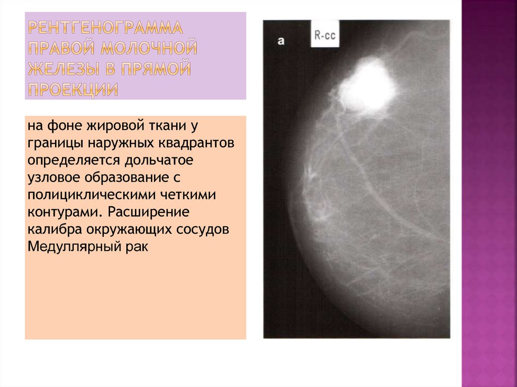 рентгенограмма правой молочной железы в прямой проекции