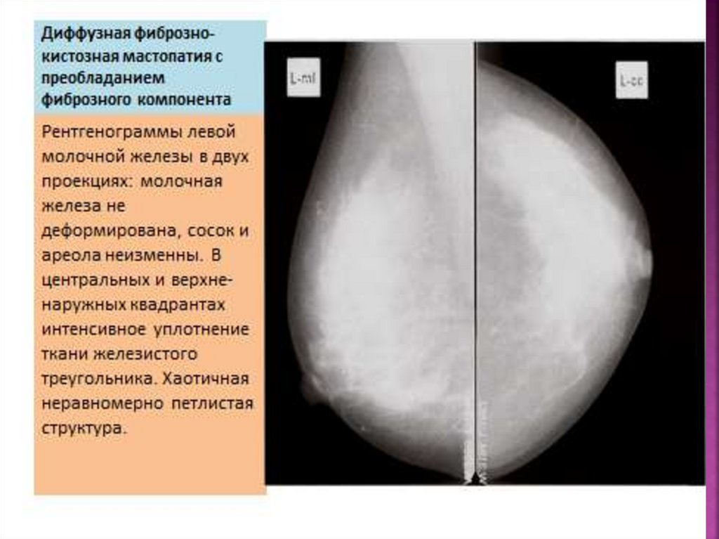 Двухсторонняя диффузная. Диффузная мастопатия молочной железы рентген. Фиброзно-кистозная ткань молочной железы. Диффузная мастопатия молочной железы что это. Фиброзно-кистозные изменения молочных желез маммография.