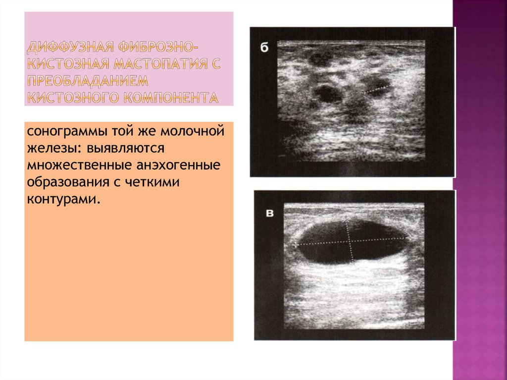 Фиброзно кистозная мастопатия это. Фиброзно кистозная мастопатия молочной железы на УЗИ. Диффузная кистозная мастопатия на УЗИ. УЗИ молочных желез кистозно фиброзная мастопатия. УЗИ признаки ДФКМ молочных желез.