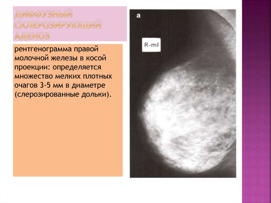 Что значит молочных желез. Аденоз молочных желез на маммографии. Склерозирующий аденоз молочных желез на рентгене что это. УЗИ локальный аденоз молочной. Аденоз мастопатия молочной железы.