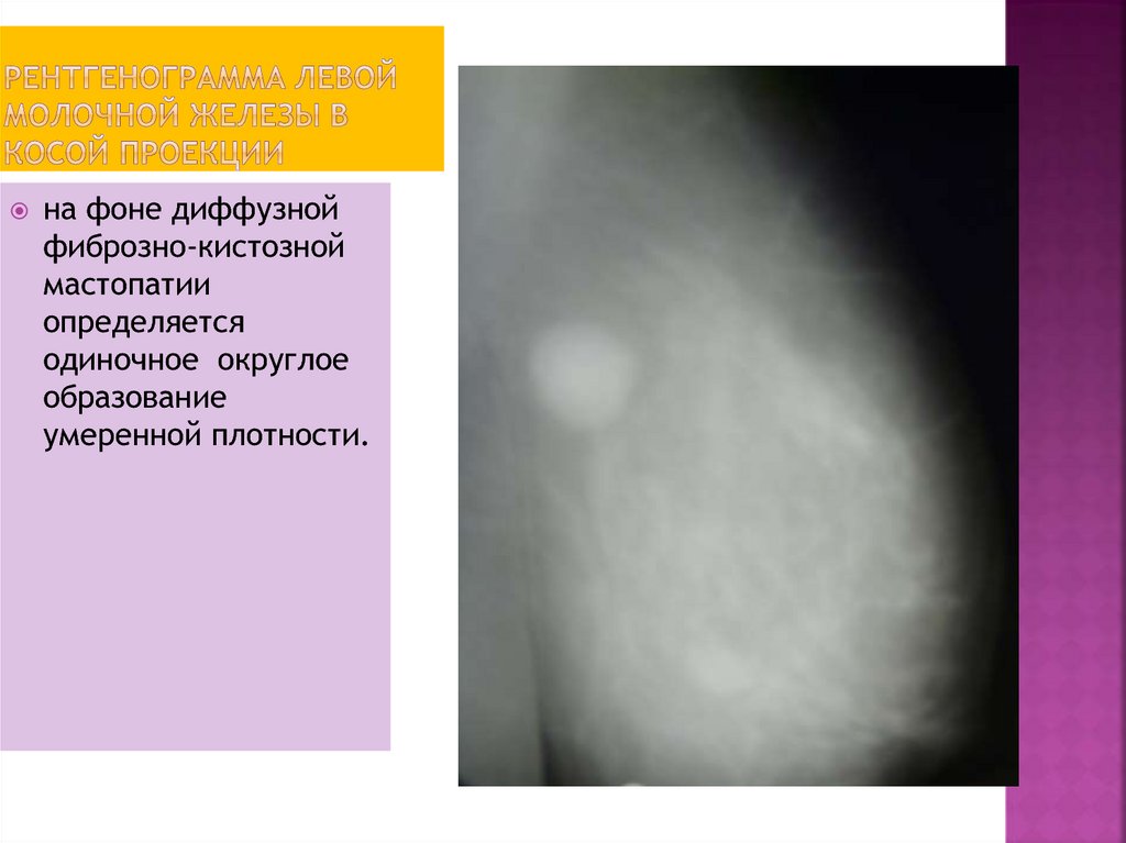 рентгенограмма левой молочной железы в косой проекции
