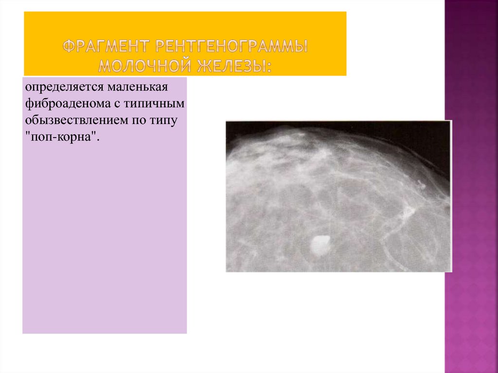 Аденоз на маммографии. Фиброаденома молочной железы рентген. Фиброаденома молочной железы birads 4 УЗИ. Маммография фиброаденома. Обызвествленная фиброаденома молочной железы.