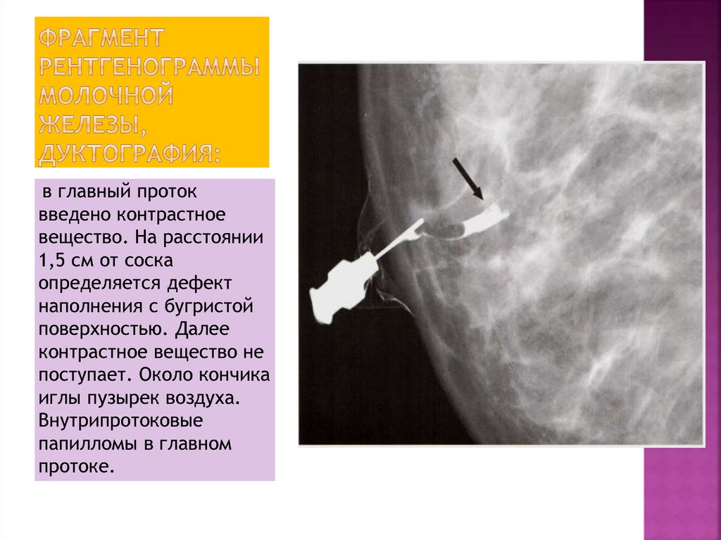 Фрагмент рентгенограммы молочной железы, дуктография: