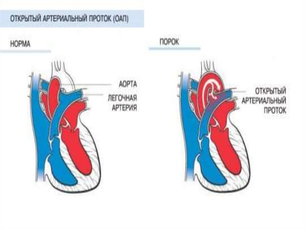 Оап у новорожденных. Врожденный порок сердца открытый артериальный проток. Открытый артериальный (боталлов) проток. Открытый артериальный проток Баталов. Открытый аортальный проток рисунок.