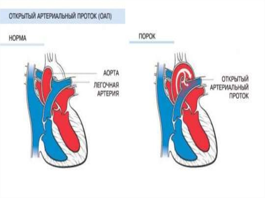 Функционирующий артериальный проток. Врожденный порок сердца открытый артериальный проток. Открытый артериальный (боталлов) проток. Открытый артериальный проток (ОАП). Открытый артериальный проток у детей гемодинамика.