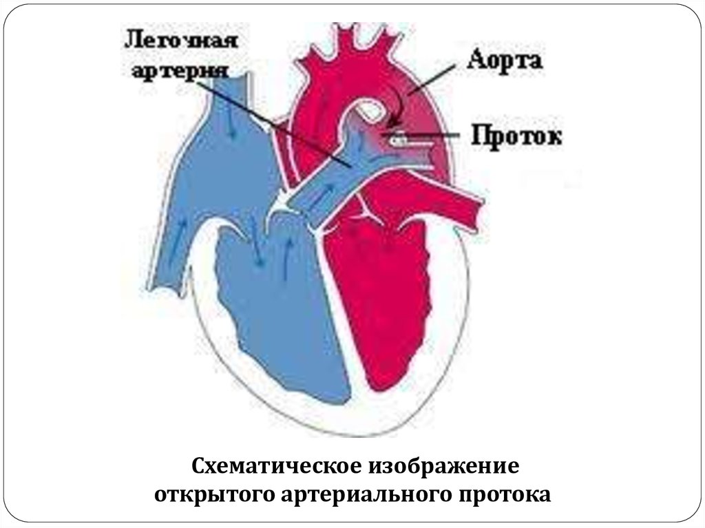 Открытый артериальный проток презентация