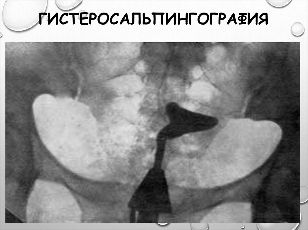 Гсг. Гистеросальпингография схема. Гистеросальпингография презентация.