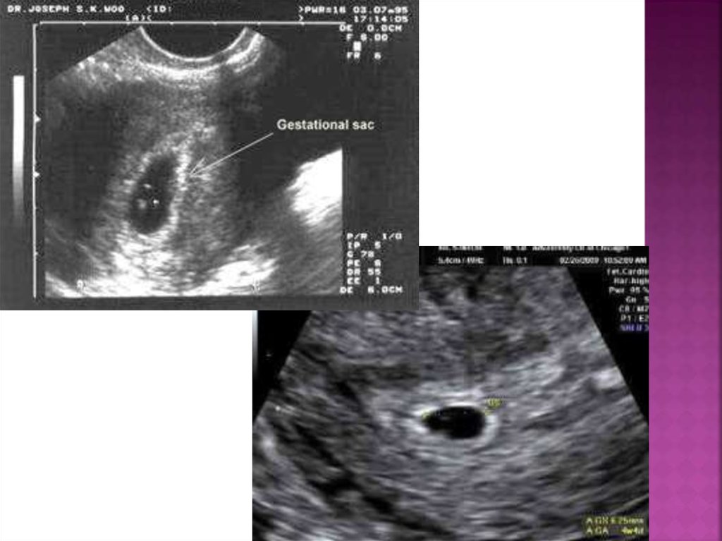 Трансвагинальное узи на ранних сроках беременности. Трансвагинальное УЗИ 1 триместр. Интерстициальная беременность по УЗИ. Трансвагинальное УЗИ С эмбрионом. Трансвагинальное сканирование первого триместра.