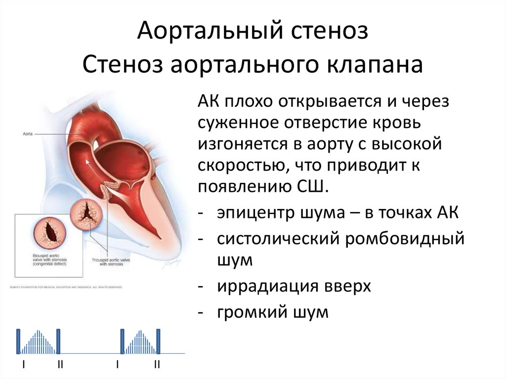 Осложнения стеноза. Стеноз аортального клапана клапан. Стеноз двустворчатого аортального клапана. Стеноз аортального клапана аускультация. Аортальный клапан при стенозе.