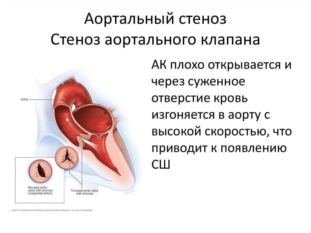 Аортальный стеноз что это такое. Стеноз аортального клапана клапан. Стеноз двустворчатого аортального клапана. Стеноз аортального клапана степени. Стеноз аортального клапана 2 степени.
